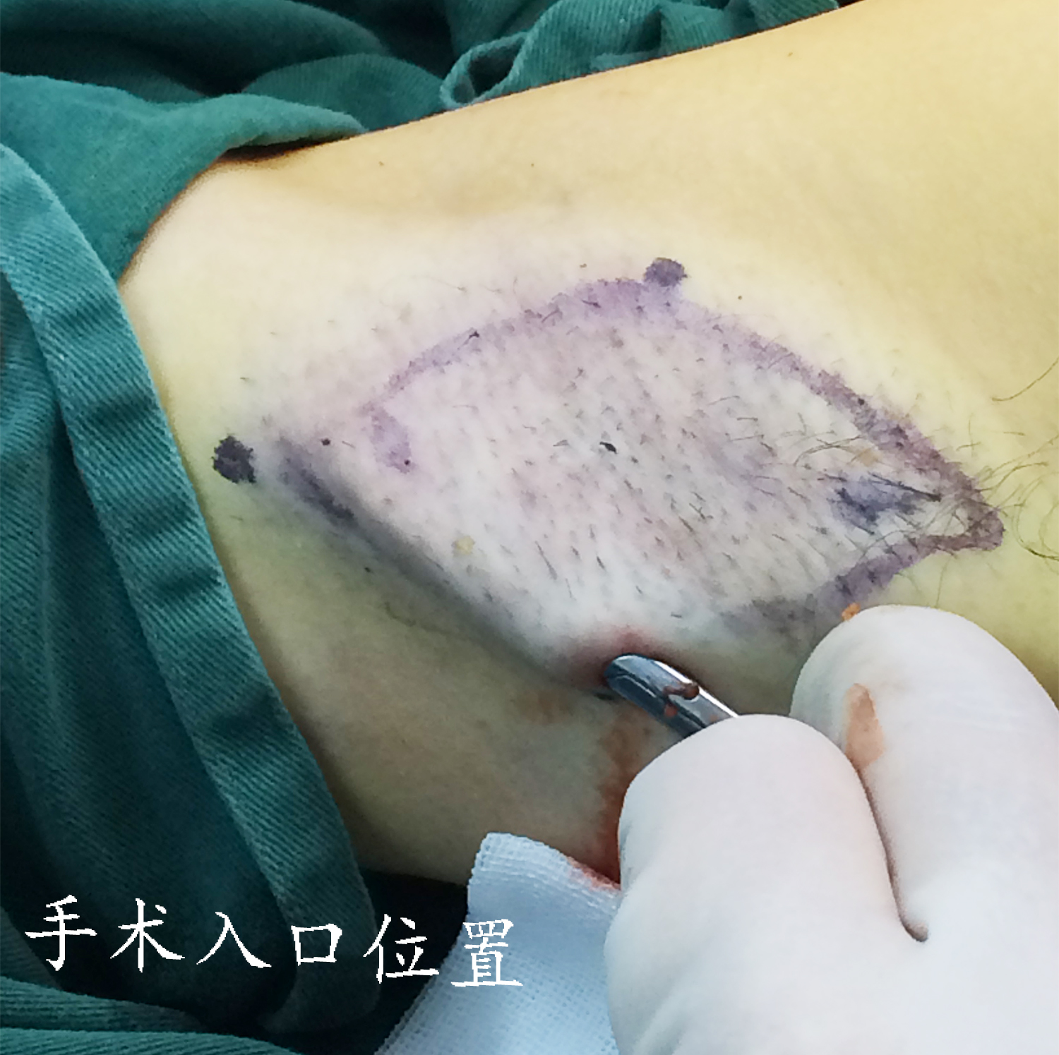 2,轻中度腋臭微创激光根治腋臭,只有2-3个直径2mm针眼.