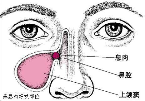 鼻炎的主要病理改变是鼻腔黏膜充血,肿胀,渗出