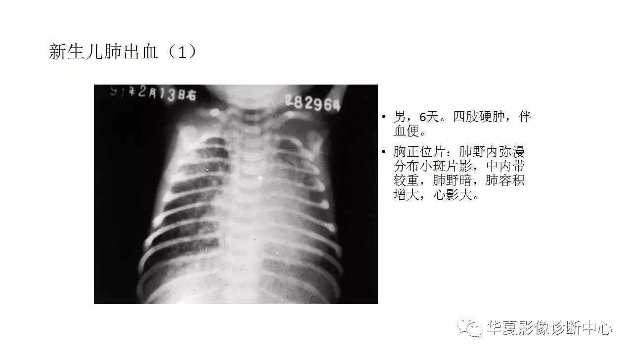 影像基础新生儿肺部常见疾病的x线诊断下