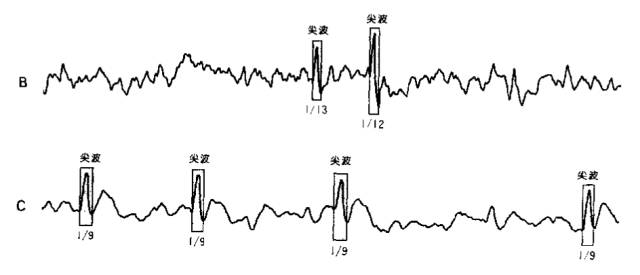 下面蓝箭头指的就是棘波: 好啦,今天的极简入门脑电图就到这里啦.