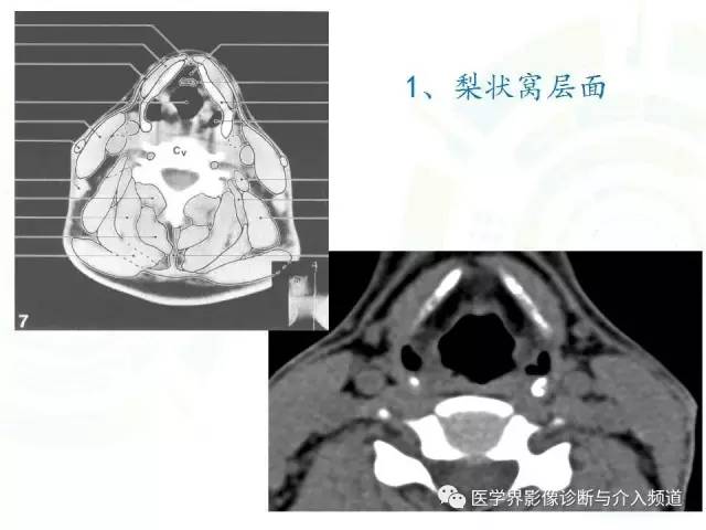 咽喉解剖,人手一份!