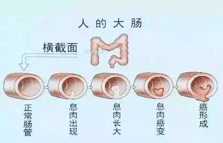 腺瘤性息肉有恶变的潜能,但是从息肉到癌变是个漫长的过程,因此患者有