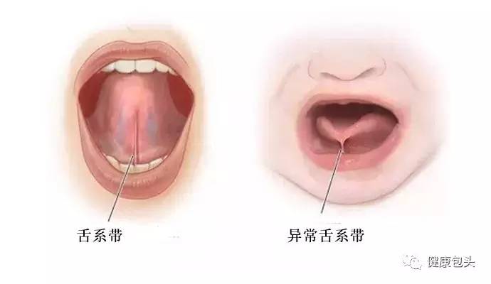 舌系带溃疡怎么办