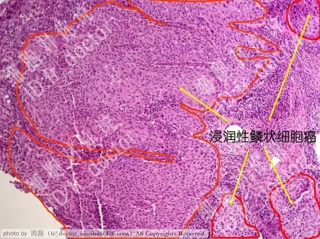 显微镜下的浸润性鳞状细胞癌|photo by 周磊