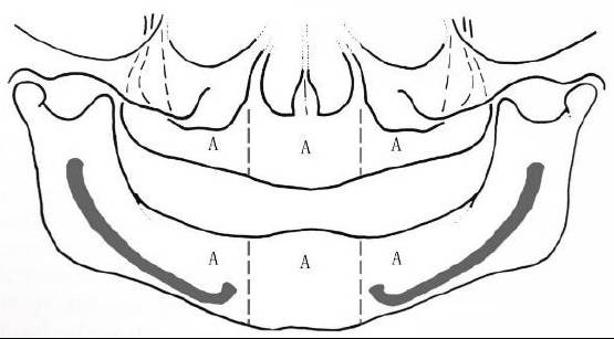 Ⅰ型a亚类牙槽嵴(图片来源于《口腔种植学》人民卫生出版社)
