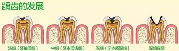 吃酸东西倒牙怎么办