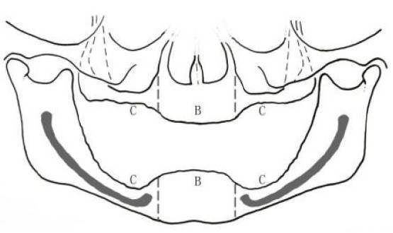 Ⅱ型ab,bc类牙槽嵴(图片来源于《口腔种植学》 人民卫生出版社)