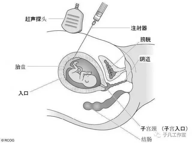 绒毛活检术