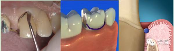 精细化备牙基本步骤(九步法)