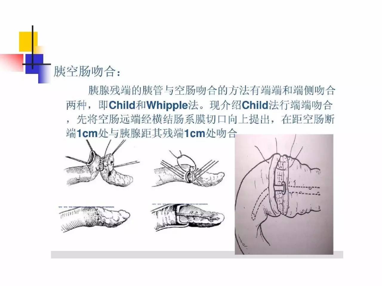 胰十二指肠切除手术护理查房