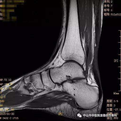 跟腱断裂你知多少盘点跟腱断裂体坛巨星刘翔难幸免