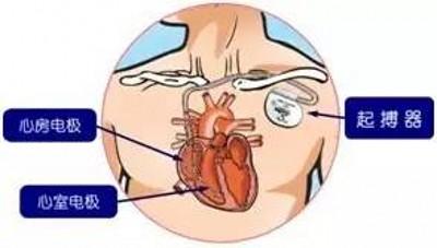 起博器植入手术复杂吗?