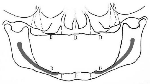 Ⅰ型d亚类牙槽嵴(图片来源于《口腔种植学》人民卫生出版社)