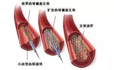 如何预防老年冠心病患者介入术后再狭窄发生