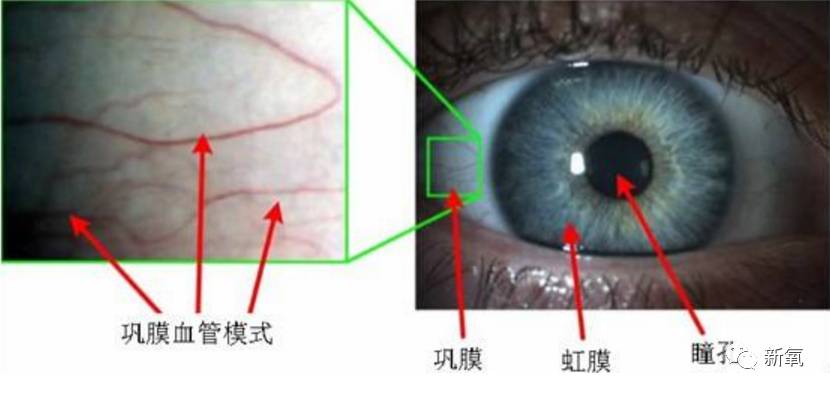 娱乐 正文  简单来说,就是人的结膜暴露在外面的部分,因为紫外线的