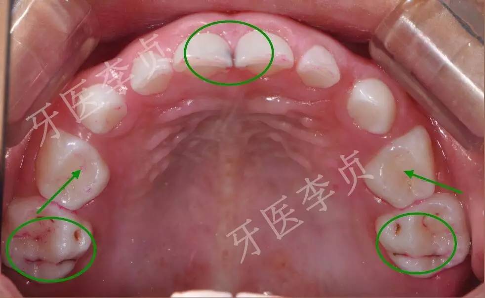 菌斑测试显示:菌斑主要附着在龈缘,上颌后牙的颊面及上下颌舌侧面.