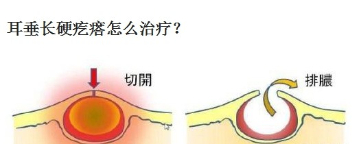 耳垂长硬疙瘩怎么治疗?