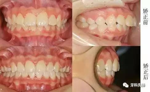 牙齿矫正案例:"龅牙妹"的蜕变之路