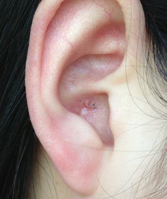 耳朵里面长"痘痘"是怎么回事--江阴惠耳助听器