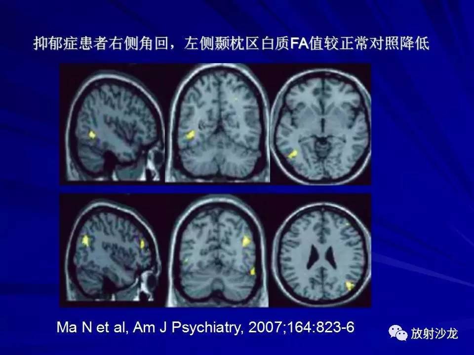 企图的患者及使用抗抑郁药治疗无效的患者可采用改良电抽搐(mect)治疗