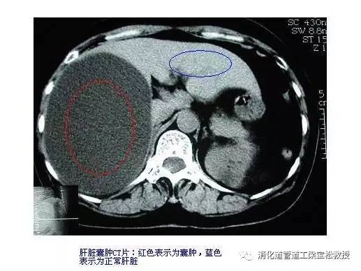 肝占位病变漫谈之二肝囊肿