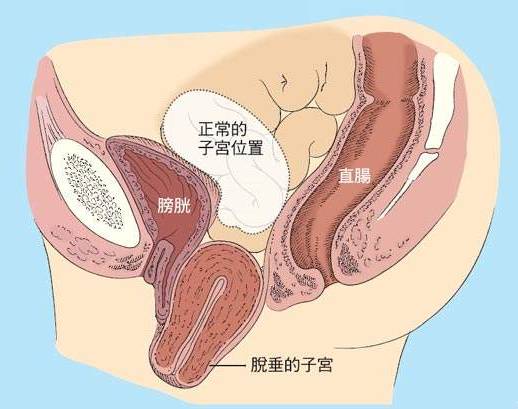 但对于活动好,无粘连发生的卵巢肿瘤,经阴道后穹窿施行卵巢肿瘤剔除或