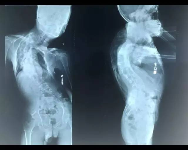 从外观上看,脊柱属于极重度侧后凸畸形,胸骨和骨盆也因此变形,更严重