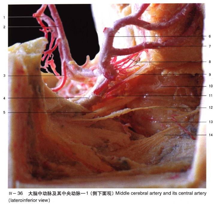 介入微课堂│珍藏系列之最全面的大脑中动脉【绘图 dsa 实体解剖】