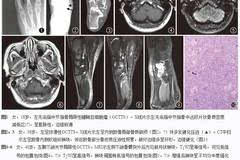 腱鞘巨细胞瘤的影像表现特征