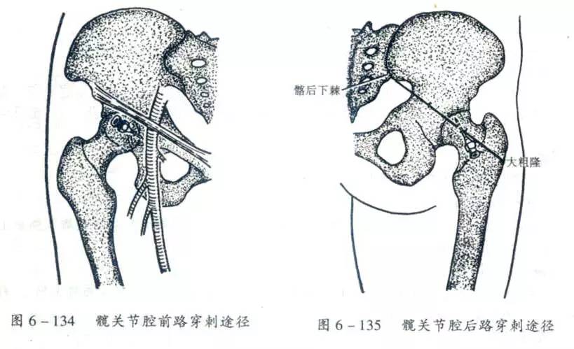 髋,膝,踝,肩,肘,腕关节穿刺技巧