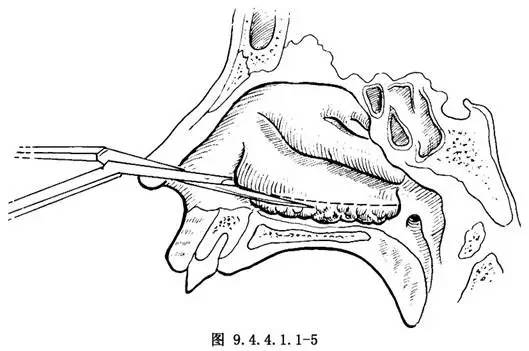 下鼻甲切除术