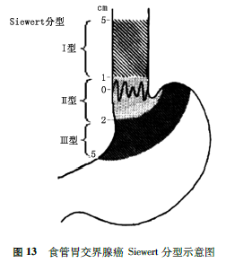 从2000年第3版开始,who消化系统肿瘤病理学和遗传学分类中对食管胃