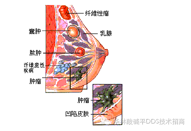 二,乳腺纤维腺瘤会发展成乳腺癌吗?