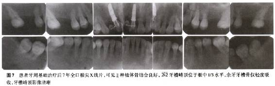 侵袭性牙周炎患者长期综合治疗一例