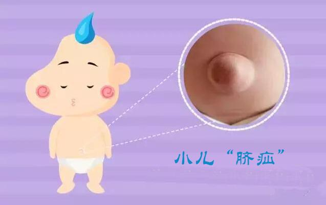 脐疝是指脐带脱落后,宝宝的脐孔部位有圆形的肿块凸出,当宝宝啼哭时