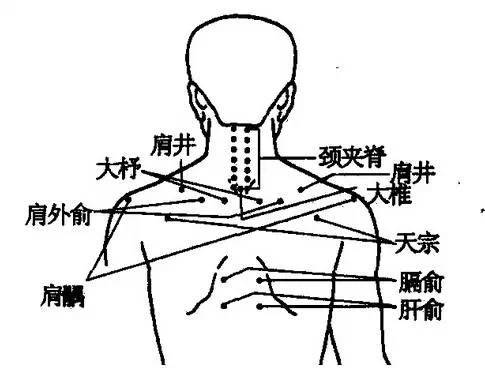 夹脊穴透刺配合走罐治疗腰椎间盘突出症83例临床报告