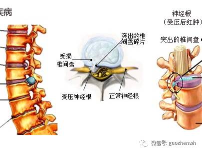 腰椎间盘突出的症状及治疗方法