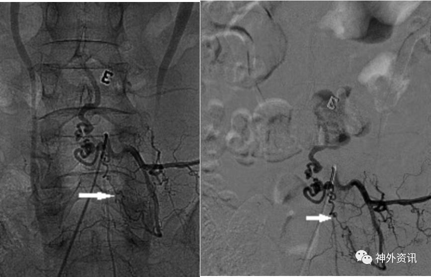 dsa检查显示瘘口(白色箭头所示)位于腰4椎体水平,左侧腰4腰动脉的