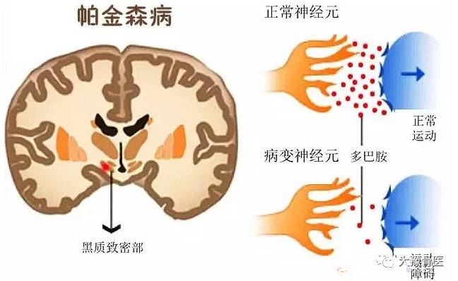 健康|世界帕金森病日:你可能误解的帕金森病