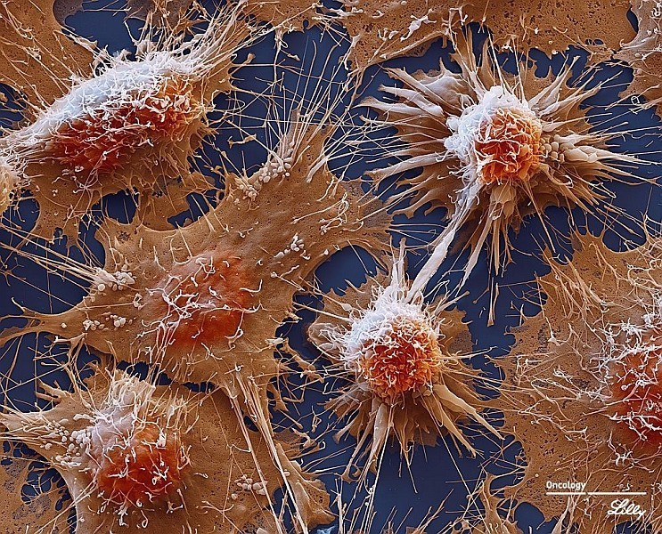 电子显微镜下的癌细胞