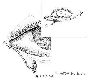 老年性睑内翻矫形术