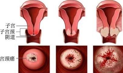 宫颈癌能治好吗