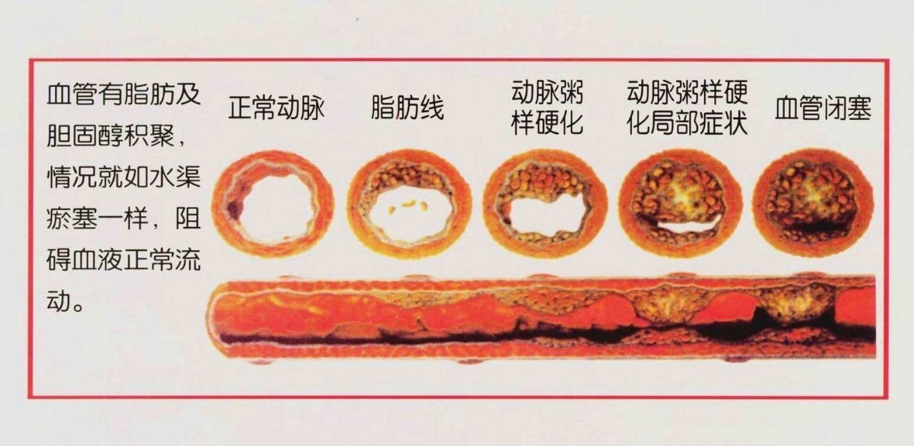 【松鹤富丽】血管是如何一天天堵塞的?一看吓一跳!