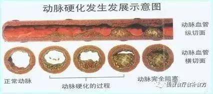 动脉硬化会如何危害生命?解析动脉硬化的病因