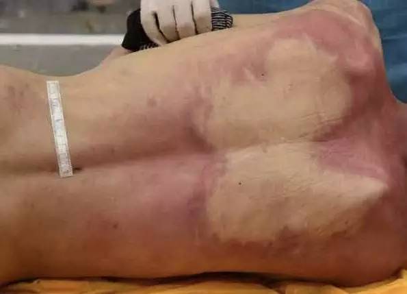 这些痕迹经过多位泸县和外地法医认定就是尸斑,而不是被殴打的伤痕 .