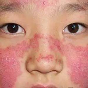 红斑丘疹鳞屑性皮肤病常见的有瘙痒症,神经性皮炎及寄生虫妄想症.