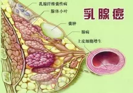 东莞人最易患3种癌症,一旦发现基本就是晚期!一定要做