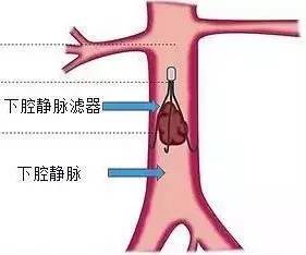 下腔静脉滤器的置