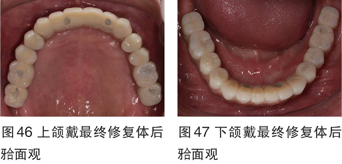 2016bitc银奖病例全口无牙颌种植固定修复一例