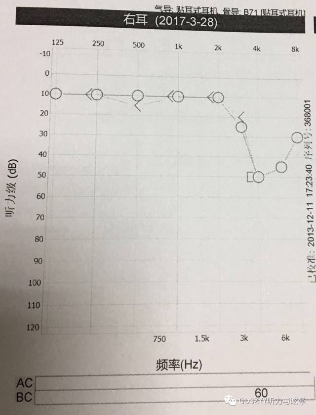 检查结果如图 结果分析 右耳感音神经性听力损失.在4khz